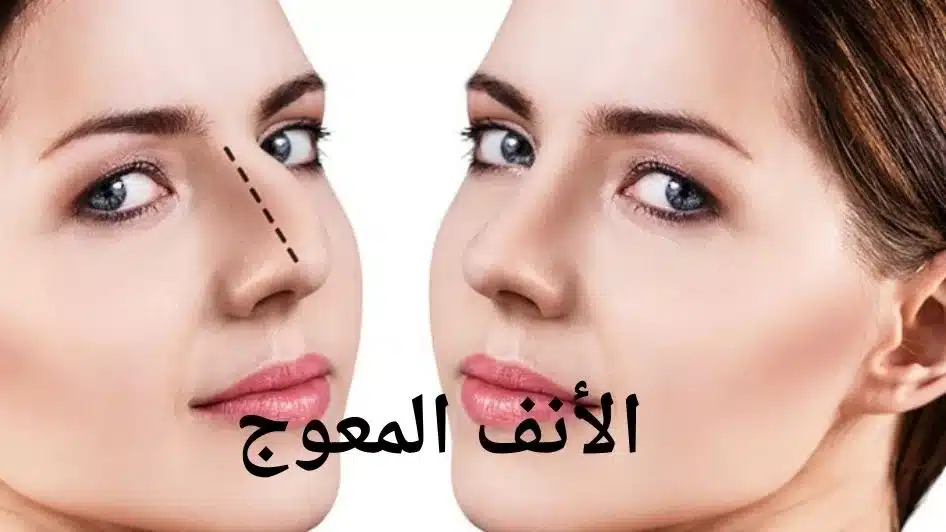 أنف ملتوي